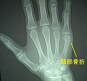 Fracture